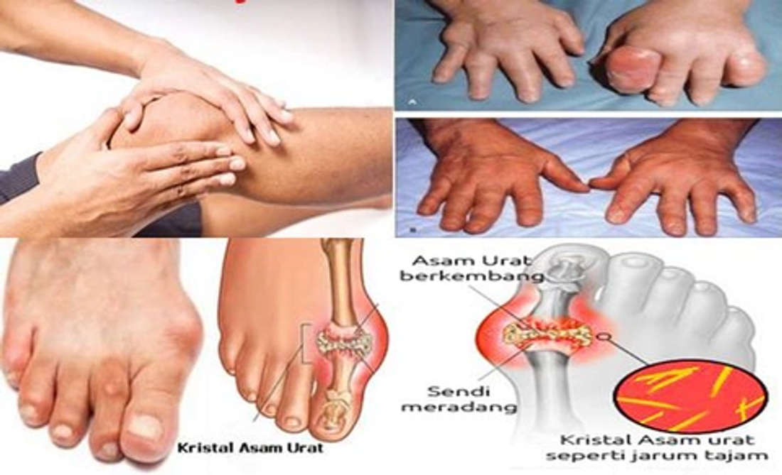 Dampak Bahaya Penyakit Asam Urat Dampak Bahaya Penyakit Asam Urat