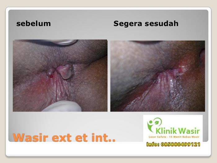 Dokumentasi Klinik Wasir Safute Prabeswari 1