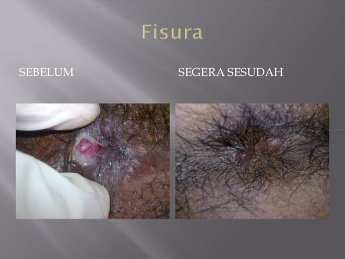Dokumentasi Klinik Wasir Safute Prabeswari 10