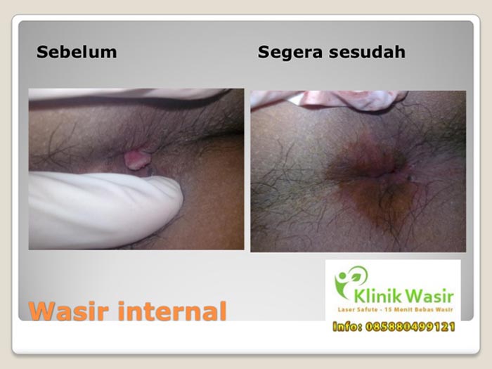 Dokumentasi Klinik Wasir Safute Prabeswari 11