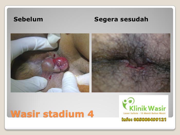 Dokumentasi Klinik Wasir Safute Prabeswari 2