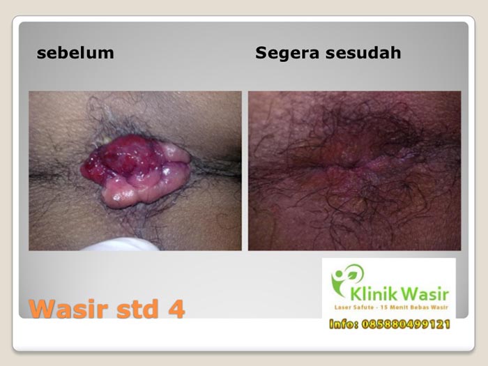 Dokumentasi Klinik Wasir Safute Prabeswari 3