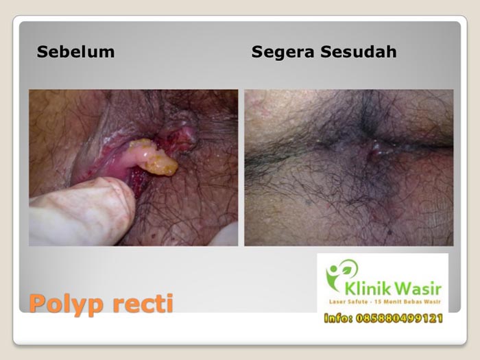 Dokumentasi Klinik Wasir Safute Prabeswari 4