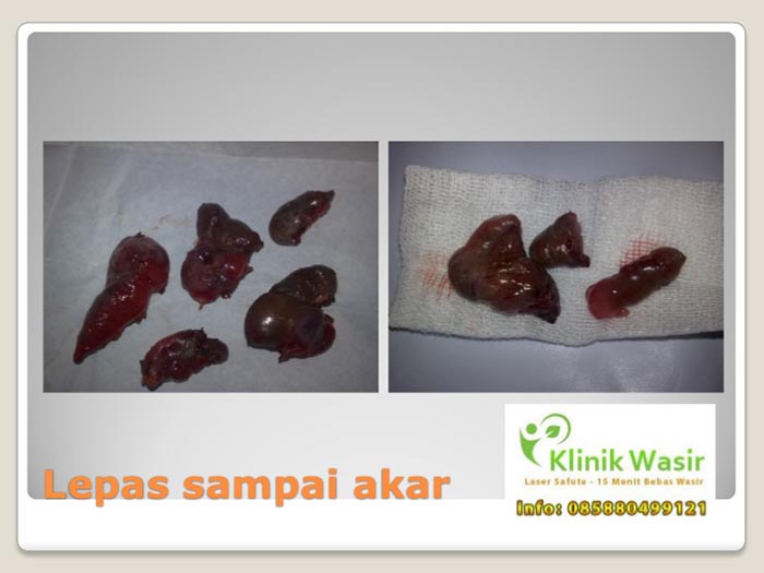 Dokumentasi Klinik Wasir Safute Prabeswari 6