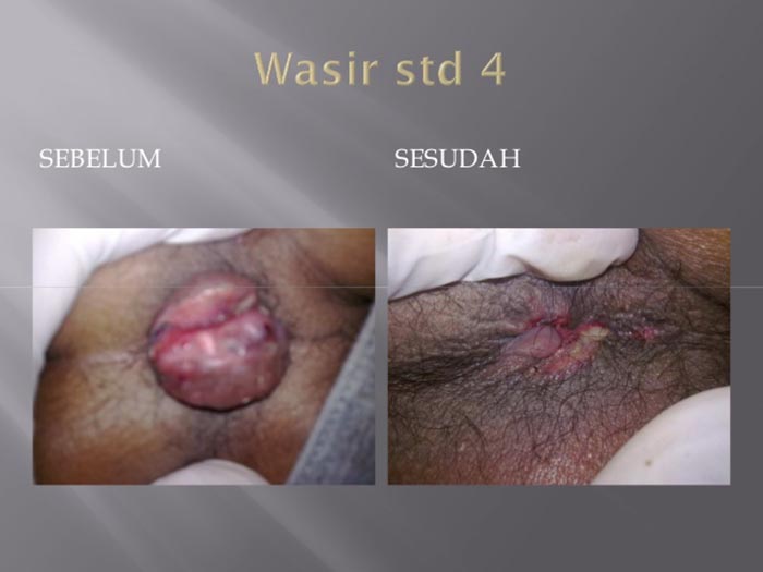 Dokumentasi Klinik Wasir Safute Prabeswari 7
