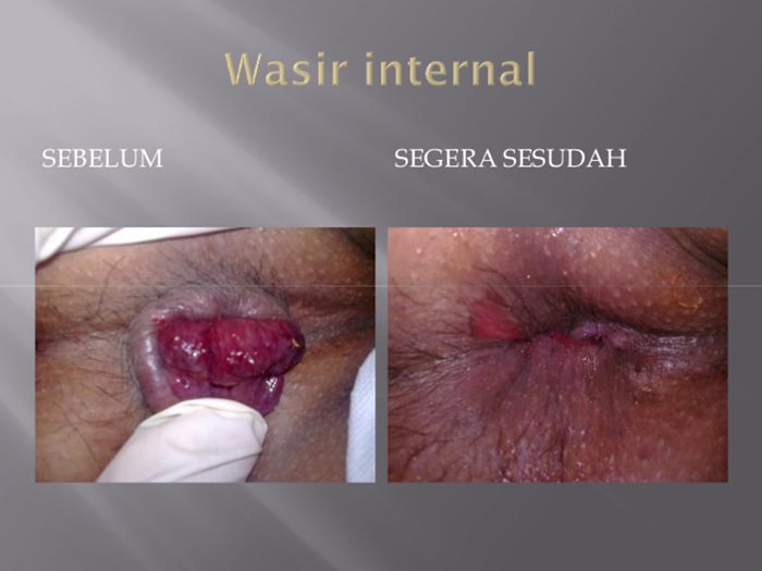 Dokumentasi Klinik Wasir Safute Prabeswari 8